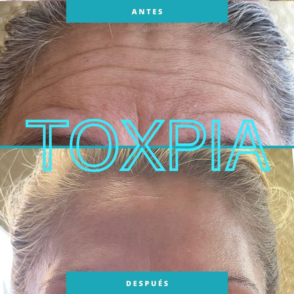 Resultados 2 - Toxpia